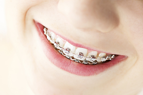 Braces in St. Louis